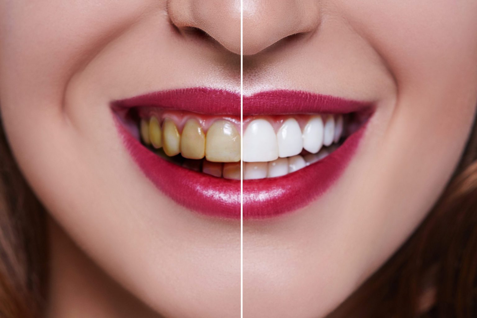 Are Veneers Safe? SantiHealth